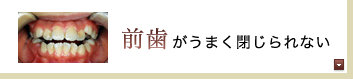 前歯がうまく閉じられない